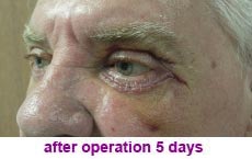 plastic-surgery-blepharoplasty